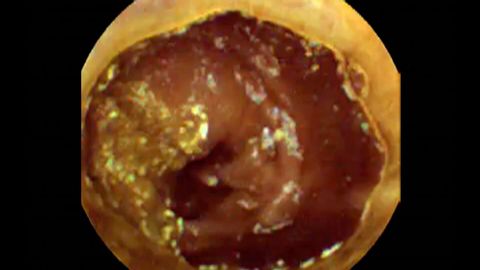 飲み込まれた錠剤カメラ｜腸をたどる｜腸｜地球科学 (Pill Camera Swallowed | Follow Through Gut | Guts | Earth Science)