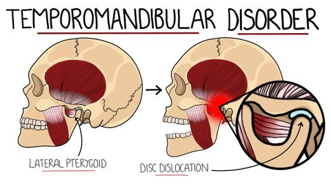 Temporomandibular Joint Disorder Explained (TMJ Dysfunction) | Includes Treatment & Anatomy